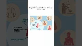 Superior mesenteric artery syndrome kattrucate medicalreels superior artery syndrome exercise [upl. by Noyart]