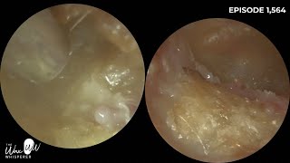 1564  Bilateral Rare Canal Cholesteotoma Patient Waiting 25 Years to be seen by ENT [upl. by Eolanda]