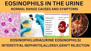 EOSINOPHILS IN URINENORMAL RANGE CAUSES OF EOSINOPHILS IN URINELYMPHOCYTES MONOCYTES IN URINE [upl. by Edmea]