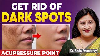 How To Cure Hyperpigmentation  How To Get Rid Of Dark Spots On Your Face [upl. by Yrelbmik]