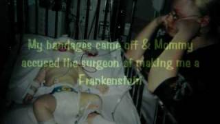 A Craniosynostosis Journey [upl. by Jerroll795]