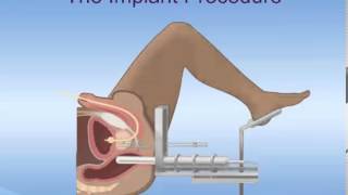 Brachytherapy for Prostate Cancer [upl. by Oran]