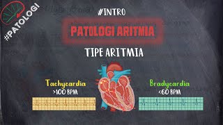 Patologi Aritmia  Tipe Aritmia [upl. by Arreip]