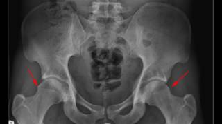 Femoroacetabular Impingement [upl. by Etra523]