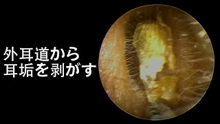 Relaxing Earwax Removal Peeling the earwax off ear canal [upl. by Skerl]