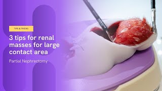 3 tips for renal masses with large contact area  Partial Nephrectomy [upl. by Wester]