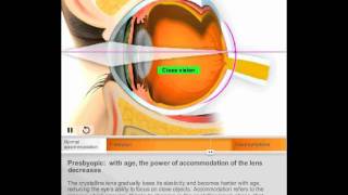 Presbyopia by Quantel Medical [upl. by Nattie]