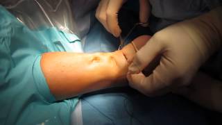 Percutaneous Achilles Tendon Surgery Repair Unedited by Kevin R Stone MD [upl. by Anirok]