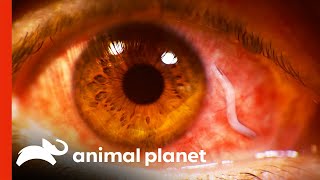 Doctors Remove Huge Parasite From Eyeball  Monsters Inside Me [upl. by Huebner643]