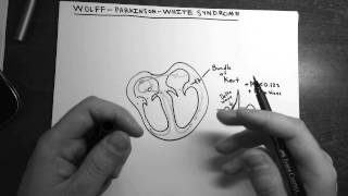 WolffParkinsonWhite Syndrome [upl. by Nyrmac]