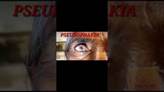 Pseudophakia l Ophthalmology l Medicine l Crazy medz l shorts [upl. by Esinert]