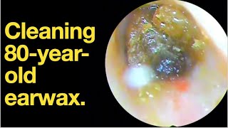 Cleaning 80yearold earwax ear wax removal  ear cleaning  ASMR  relaxation  relax [upl. by Kata]