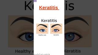 Keratitis Shorts Disease CPC Exam Medical Coding and Billing [upl. by Joel]