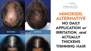 Limitations of Minoxidil and Why its Not Needed After the TrichoStem Hair Regeneration Treatment [upl. by Nuarb443]