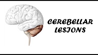 Cerebellar Lesions  Clinical Examination for Cerebellar Examination [upl. by Llirrehs]