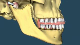 Avance mandibular  Ortodoncia [upl. by Yduj434]