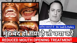 Reduced Mouth Opening Treatment । munh kaise khole। OSMF [upl. by Lash575]