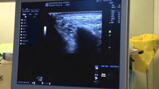 TRIGEMINAL NERVE BLOCK ultrasound guided [upl. by Hephzipah187]