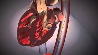 Cardiologie  TAVI Procedure EdwardsXT [upl. by Clippard441]