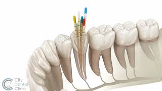 Endodontics  Root canal treatment  City Dental Clinic Bratislava [upl. by Eiramait]