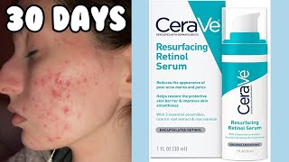 I TRIED THE CERAVE RESURFACING RETINOL SERUM FOR MY ACNE  1 Month Test [upl. by Aeuhsoj]