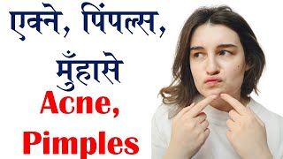 Acne Pimples मुँहासा मुहाँसे acne acnetreatment acneremoval acnescars acnecauses [upl. by Nanji]