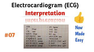 How to Read an ECG interpretation  07 QTQTc Interval [upl. by Laroy]