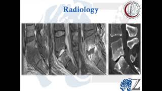 CNS Infection 9 Spondylodiscitis التهاب الفقرات [upl. by Htez]