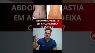 ABDOMINOPLASTIA EM ANCORA DEIXA MARCA shorts shortvideo [upl. by Leese]