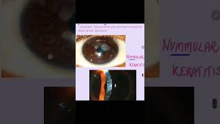 Nummular keratitis cornea keratitis eyes ophthalmology [upl. by Kcirdorb]