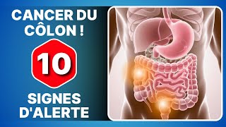 10 symptômes qui montrent que vous devez faire une coloscopie durgence [upl. by Ahseinar]