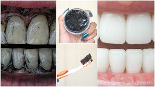 DIY CHARCOAL Teeth Whitening│How To Make Charcoal Toothpaste at Home For White Teeth in MINUTES [upl. by Ahsata277]