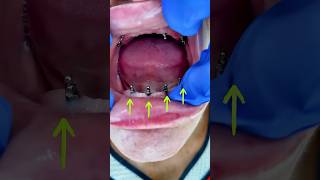 The dental prosthesis on implant dentalimplant mrdent viral [upl. by Bertila]