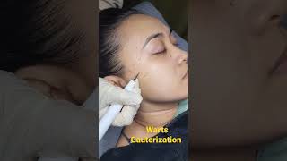 Warts Cauterization warts health wartstreatment face beauty [upl. by Grunenwald]