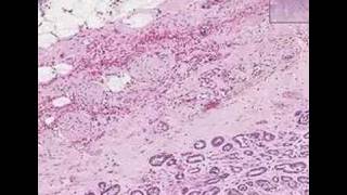 Histopathology Prostate Adenocarcinoma Gleason grade 3 [upl. by Ahtamas]