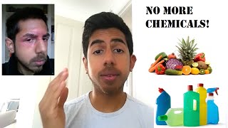 Dyshidrotic Eczema  Atopic Dermatitis  Natural Healing Tips [upl. by Noam]