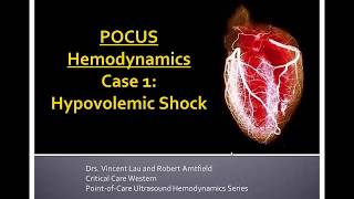 POCUS Hemodynamic Series Part 1 Hypovolemia [upl. by Keynes621]