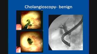 Primary Sclerosing Cholangitis Update in Management [upl. by Llatsyrc367]