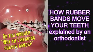 How elastics  rubber bands move teeth time lapse  Braces Explained [upl. by Yssep]