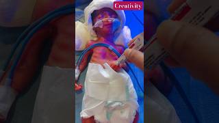 Preterm Baby Care Video nicu medical viralshort [upl. by Almallah]