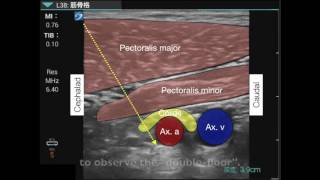 Brachial plexus infraclavicular approach [upl. by Adnilec]