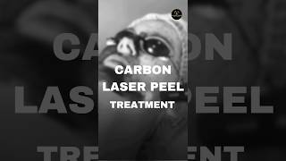 Carbon Laser Peel Treatment for Face  Procedure  Carbon Laser Peel Treatment in Delhi shorts [upl. by Naehs]