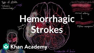 Hemorrhagic strokes  Circulatory System and Disease  NCLEXRN  Khan Academy [upl. by Emerej264]