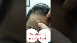 Case of swelling in midline of forehead  Lipoma  Dermoid Cyst [upl. by Sancha]