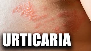 Urticaria cauze și tratament [upl. by Teeter]