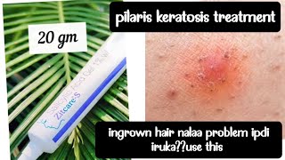 zitcare s salicylic acid gel review  pilaris keratosis treatment  acne [upl. by Anerol]