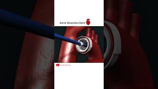 Aortic dissection Stent grafting cardiology shorts [upl. by Erund]