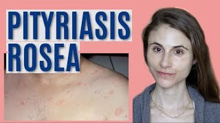 PITYRIASIS ROSEA WHAT IT IS amp GETTING RID OF IT DR DRAY [upl. by Ardnoik]