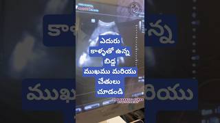 Breech presentation in 9th month drkranthigynecologist తొమ్మిదవ నెల లో ఎదురు కాళ్ళు [upl. by Fanning]