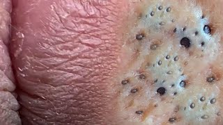 Super Satisfying Blackhead Removal [upl. by Naillig]